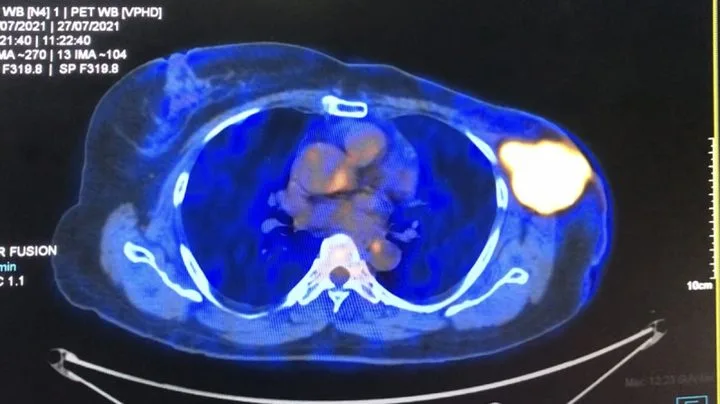 A patient, who was diagnosed with Stage IV Breast Cancer