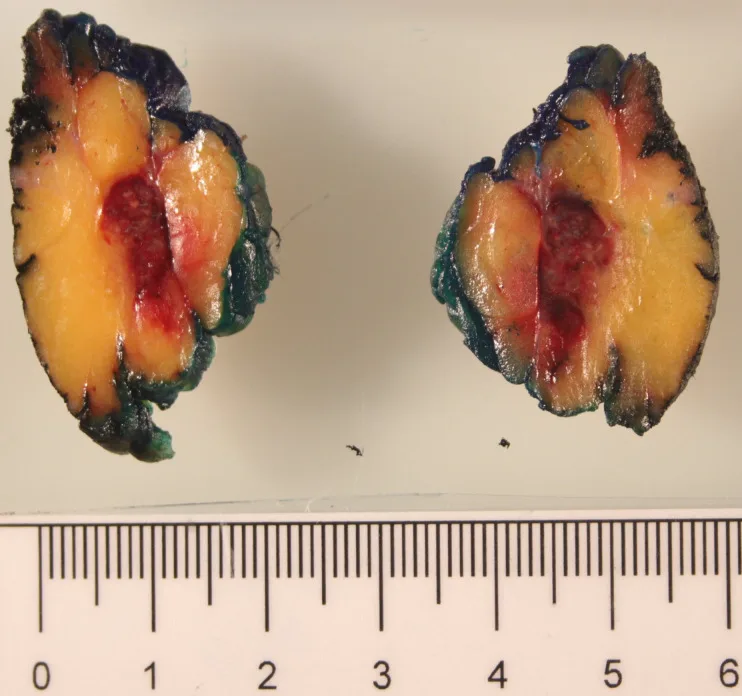 A patient, who was diagnosed with Breast Cancer