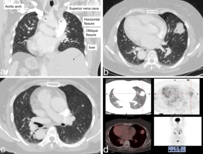 A patient, who was diagnosed with Stage I Lung Adenocarcinoma