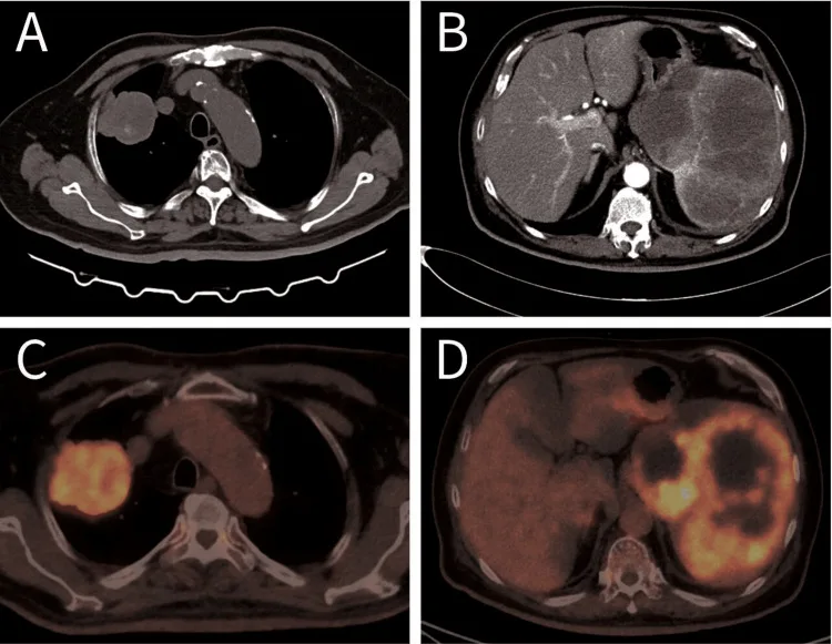 A patient, who was diagnosed with Stage IV Lung Adenocarcinoma