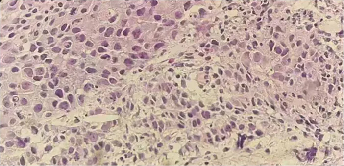 A patient, who was diagnosed with Stage IV Non-Small Cell Lung Cancer