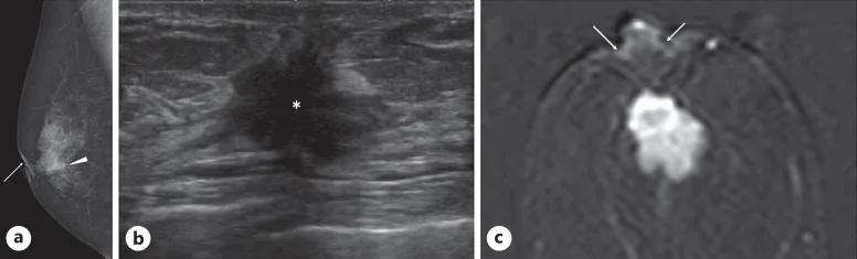A patient, who was diagnosed with Stage I Invasive Ductal Carcinoma