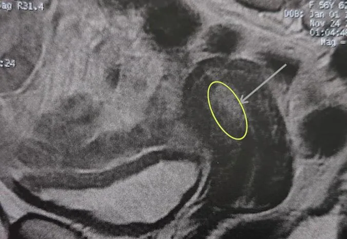 A patient, who was diagnosed with Stage IV Invasive Lobular Carcinoma