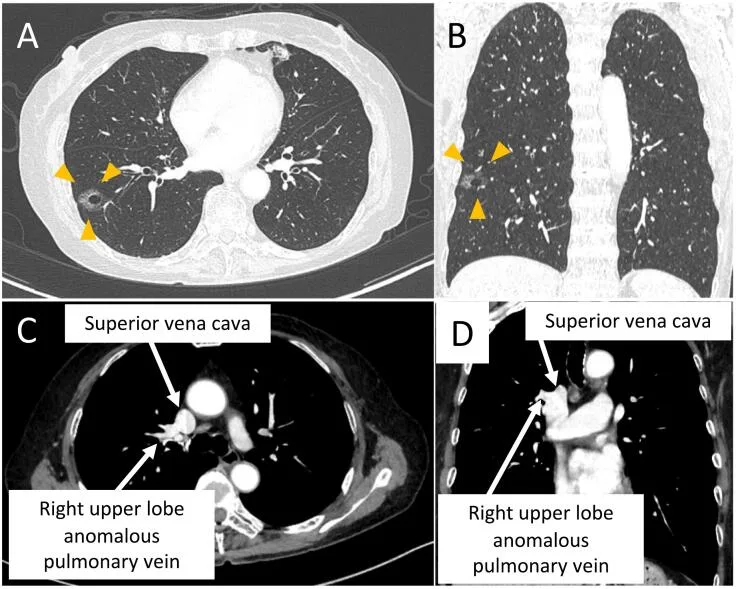 A patient, who was diagnosed with Lung Adenocarcinoma