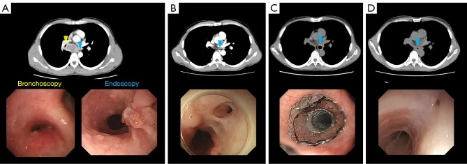 A patient, who was diagnosed with Stage III Non-Small Cell Lung Cancer