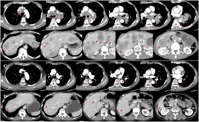 A patient, who was diagnosed with Stage IV Small Cell Lung Cancer