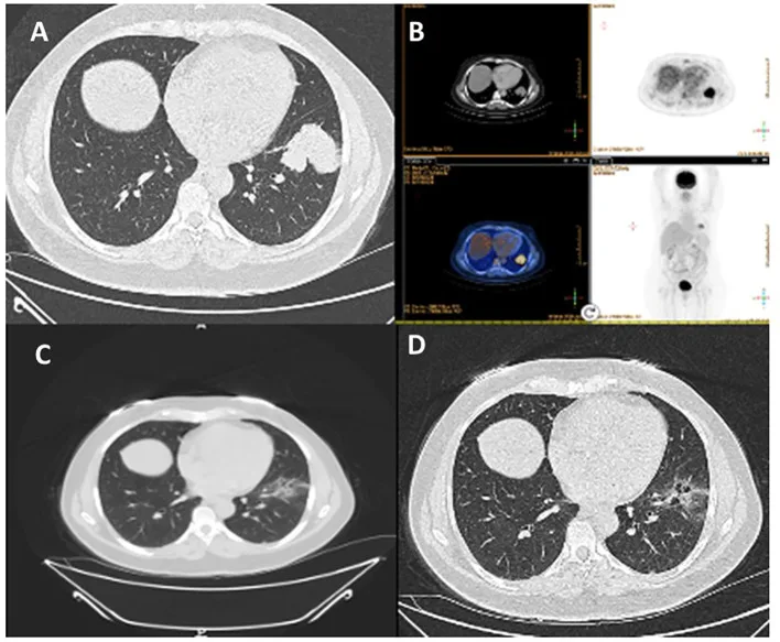 A patient, who was diagnosed with Stage III Non-Small Cell Lung Cancer