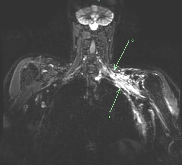 A patient, who was diagnosed with Stage I Invasive Ductal Carcinoma