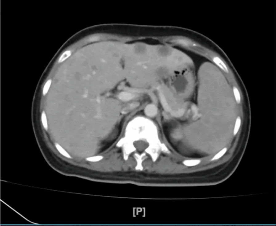 A patient, who was diagnosed with Stage IV Breast Cancer