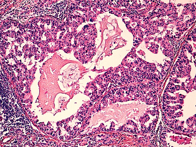A patient, who was diagnosed with Breast Cancer