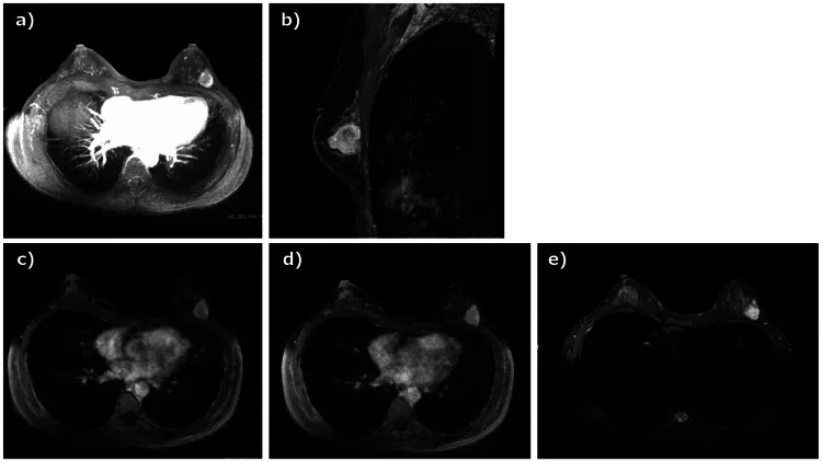 A patient, who was diagnosed with Stage I Breast Cancer