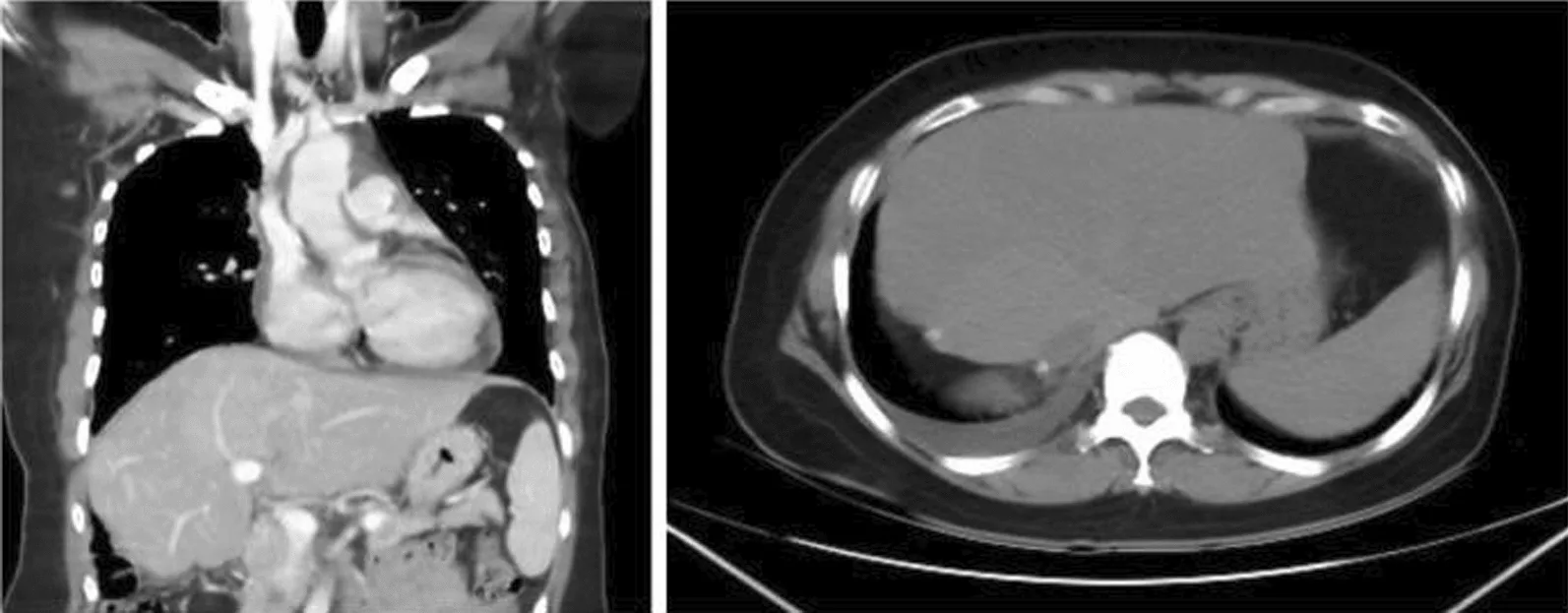 A patient, who was diagnosed with Stage IV Breast Cancer