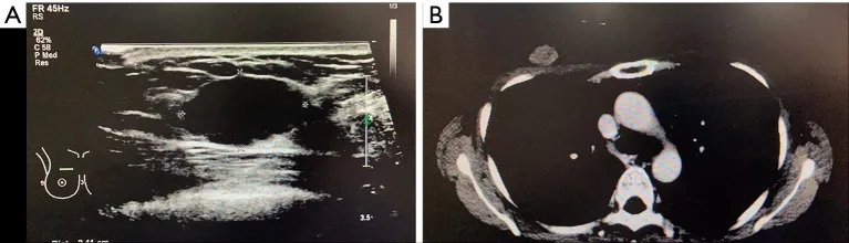 A patient, who was diagnosed with Stage II Breast Squamous Cell Carcinoma