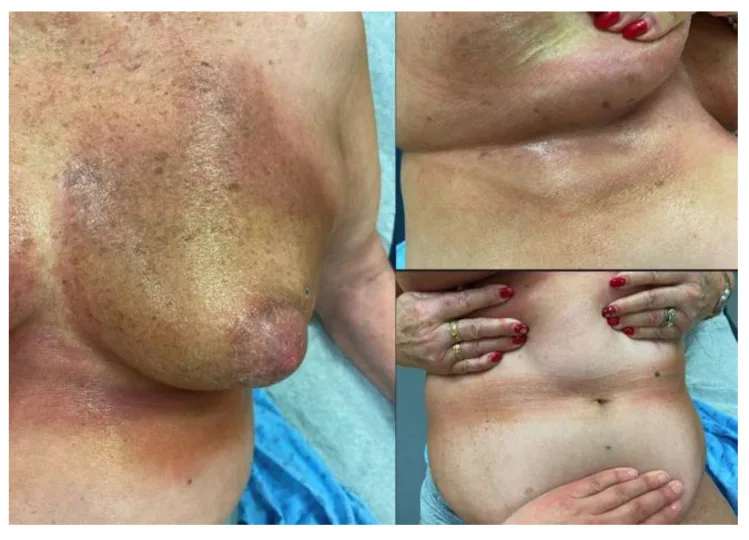 A patient, who was diagnosed with Stage I Breast Cancer