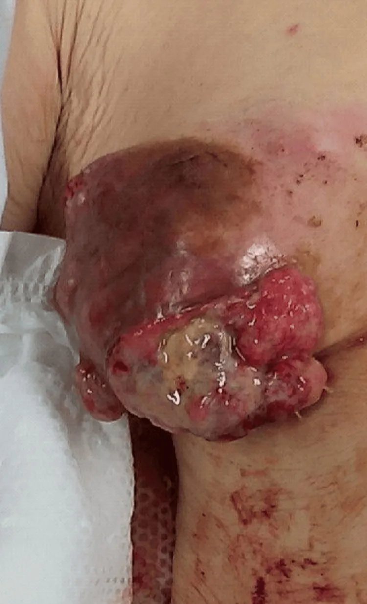 A patient, who was diagnosed with Stage III Breast Adenocarcinoma