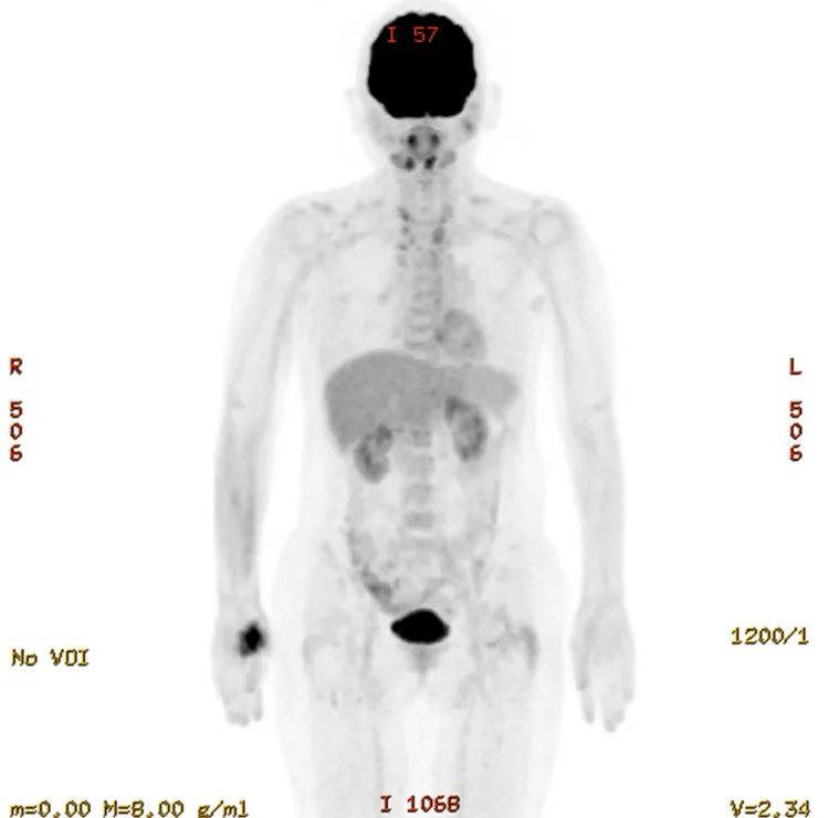 A patient, who was diagnosed with Stage IV Breast Cancer