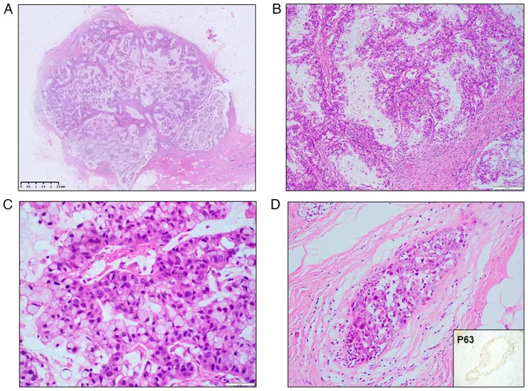 A patient, who was diagnosed with Stage II Breast Cancer