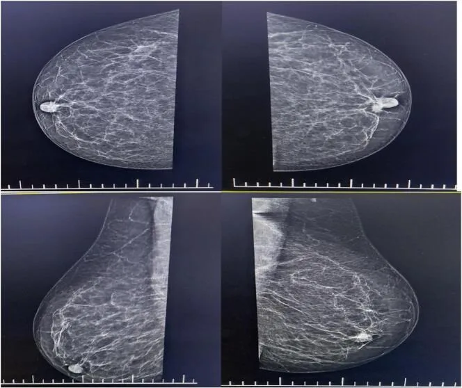A patient, who was diagnosed with Breast Cancer