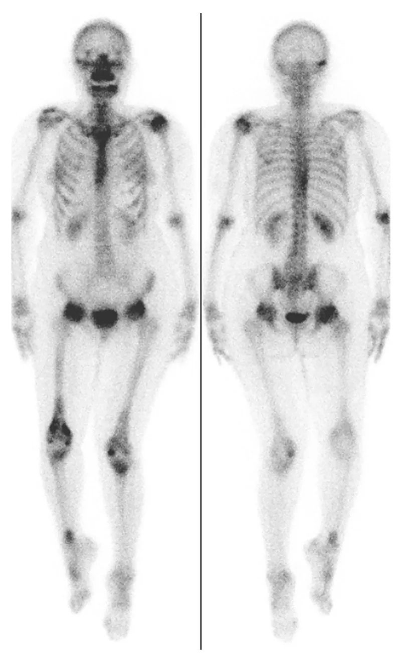 A patient, who was diagnosed with Stage I Invasive Ductal Carcinoma