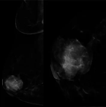 A patient, who was diagnosed with Breast Cancer
