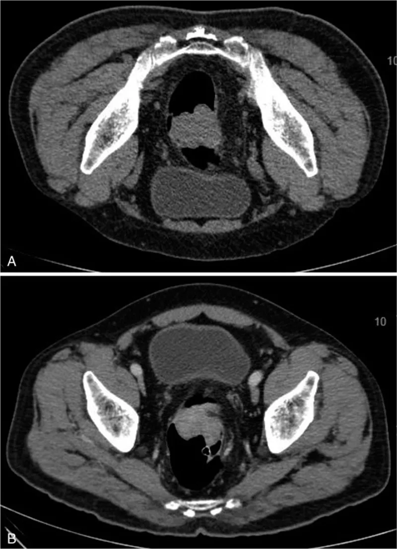 A patient, who was diagnosed with Colorectal Adenocarcinoma