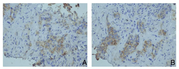 A patient, who was diagnosed with Stage IV Invasive Lobular Carcinoma