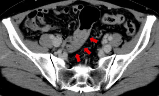 A patient, who was diagnosed with Stage III Colorectal Adenocarcinoma