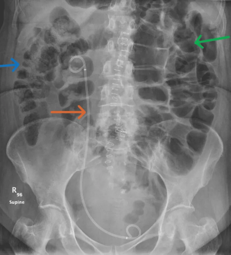 A patient, who was diagnosed with Stage IV Invasive Lobular Carcinoma