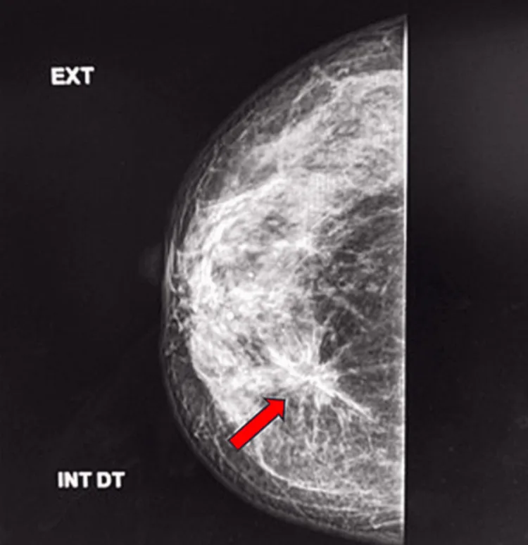 A patient, who was diagnosed with Stage II Breast Cancer