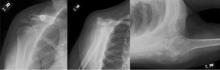 A patient, who was diagnosed with Stage IV Colorectal Adenocarcinoma
