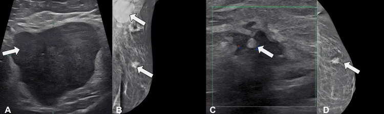 A patient, who was diagnosed with Invasive Ductal Carcinoma