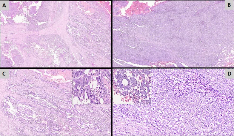 A patient, who was diagnosed with Breast Cancer