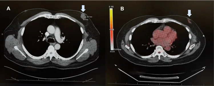 A patient, who was diagnosed with Stage II Invasive Ductal Carcinoma