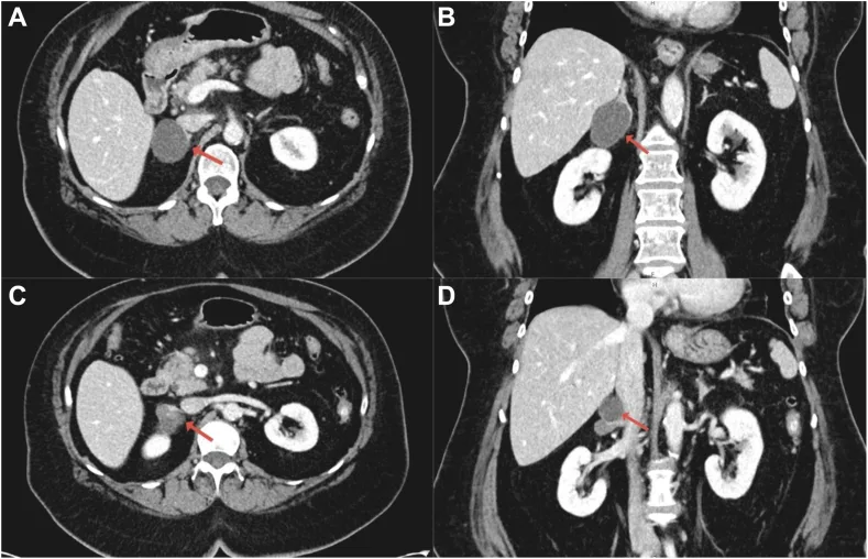 A patient, who was diagnosed with Stage IV Invasive Ductal Carcinoma