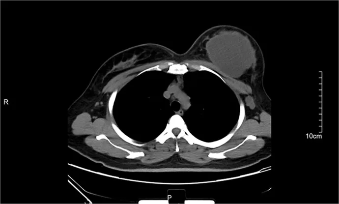 A patient, who was diagnosed with Stage III Breast Cancer