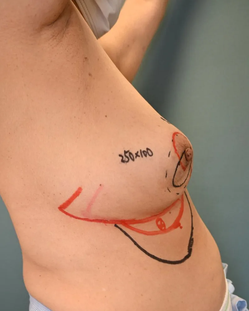 A patient, who was diagnosed with Stage II Breast Cancer