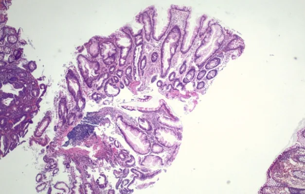 A patient, who was diagnosed with Stage III Colorectal Adenocarcinoma