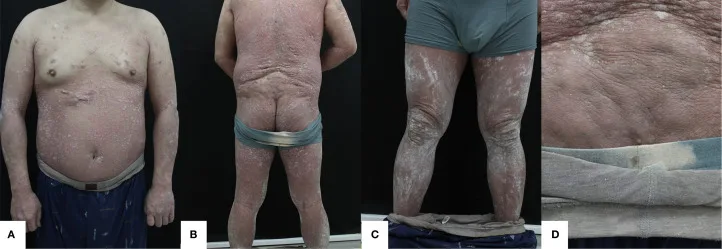 A patient, who was diagnosed with Stage IV Colorectal Cancer