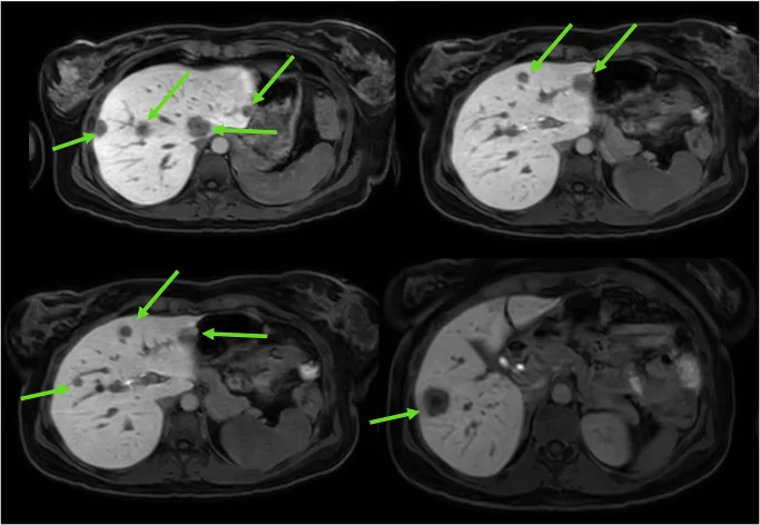 A patient, who was diagnosed with Stage IV Colorectal Adenocarcinoma