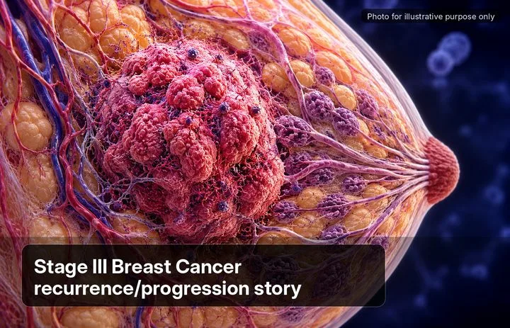A patient, who was diagnosed with Breast Cancer