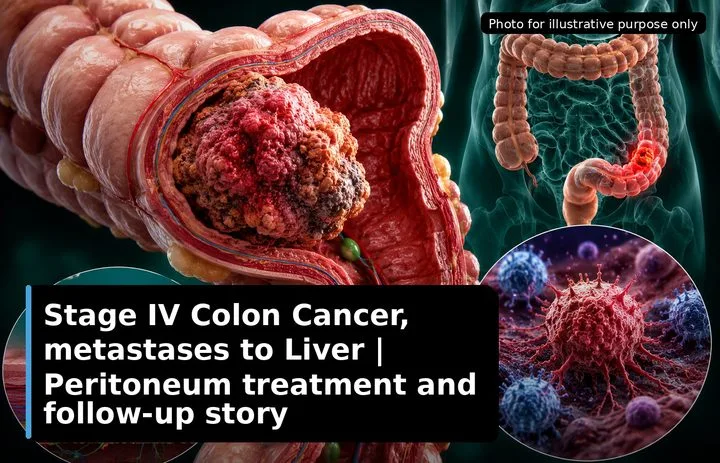 A patient, who was diagnosed with Stage IV Colorectal Cancer